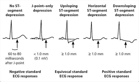 equivocal stress test meaning|The Significance of Equivocal Exercise Treadmill ECG for.